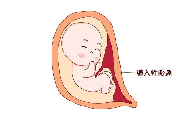 莫急莫慌！带你秒懂前置胎盘，减少人工流产
