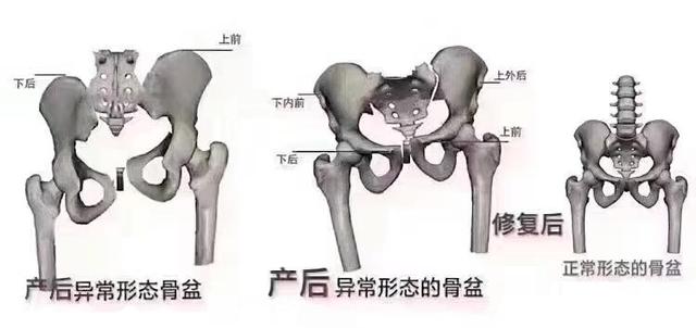 产后盆骨和盆底肌修护有多重要？它关系到宝妈身材恢复和身体健康