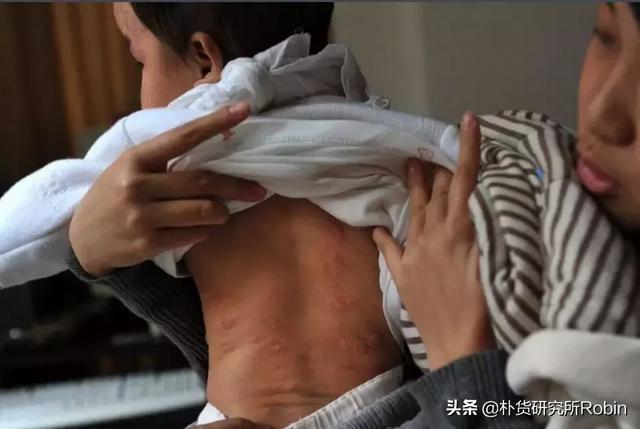 宝宝全身长包的元凶竟然是因为药浴？你错误的关心正在害死他