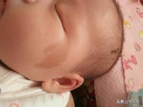 宝宝为什么会有胎记？除了遗传之外，孕期这3种行为也容易有胎记