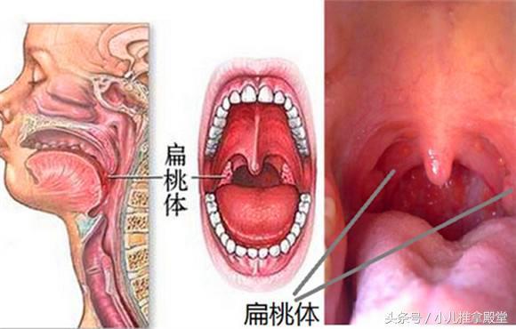 3岁宝宝反复患扁桃体炎，这个原因很常见，这次发高热竟一推就灵