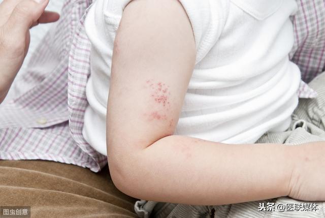 夏季高温，这个病症也会偷偷“缠上”宝宝，得及早识别