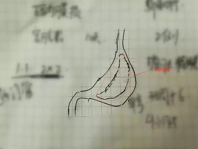 刚出生的宝宝一喝奶肚子就鼓成球，打开腹腔吓一跳：一股气体喷出