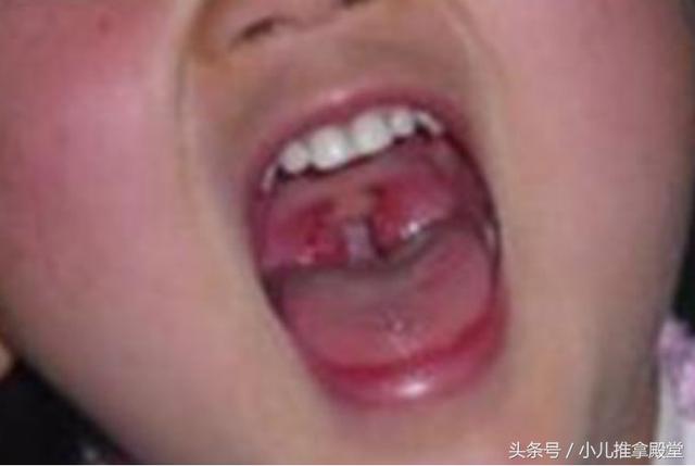 3岁宝宝反复患扁桃体炎，这个原因很常见，这次发高热竟一推就灵
