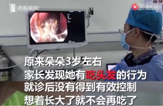 8岁女孩胃里长出结石，只因从3岁起就爱吃头发，医生这样解释