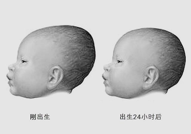 一岁内的宝宝，要关注宝宝的囟门，若出现这3种形态，别忽视