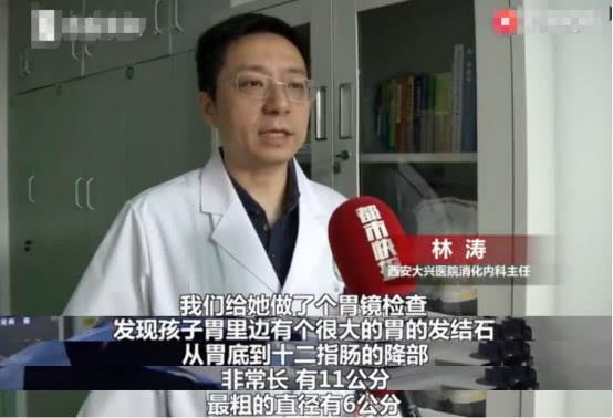 8岁女孩胃里长出结石，只因从3岁起就爱吃头发，医生这样解释