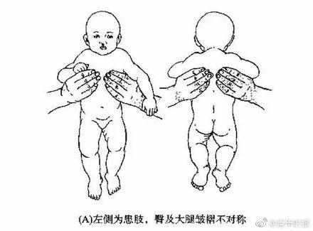 警惕！家长要多关注婴幼儿的大腿皮纹，不对称的后果挺严重