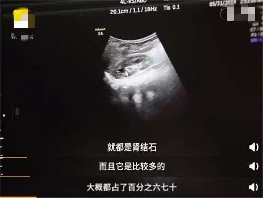 妈妈一个错误观念，致9个月大宝宝肾脏60％都是肾结石