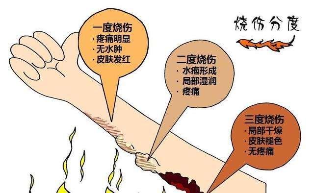 孩子烫伤腿部，到底是先脱裤子还是先冲水？一步做错伤情更严重