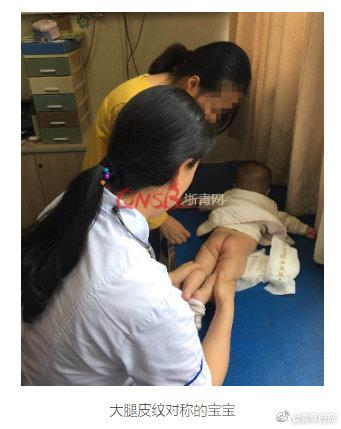 警惕！家长要多关注婴幼儿的大腿皮纹，不对称的后果挺严重