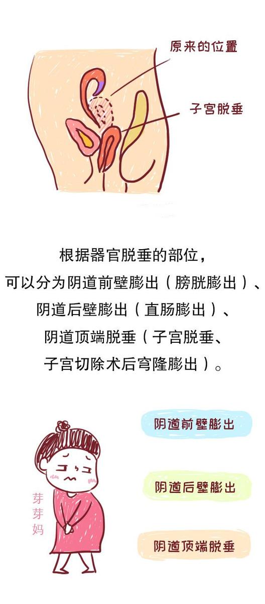 拿什么拯救你？产后妈妈的子宫脱垂，一个相避也无法避开的问题