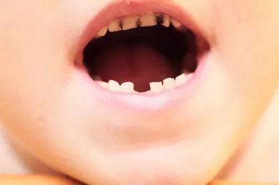 宝宝“乳牙龋”，你却还在等换牙？千万别入这个误区