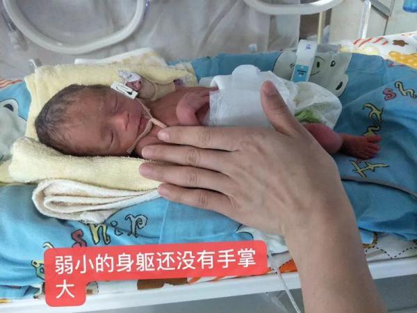 奇迹！新生儿早产体重仅 870 克，救治 73 天巴掌大宝宝跑赢死神