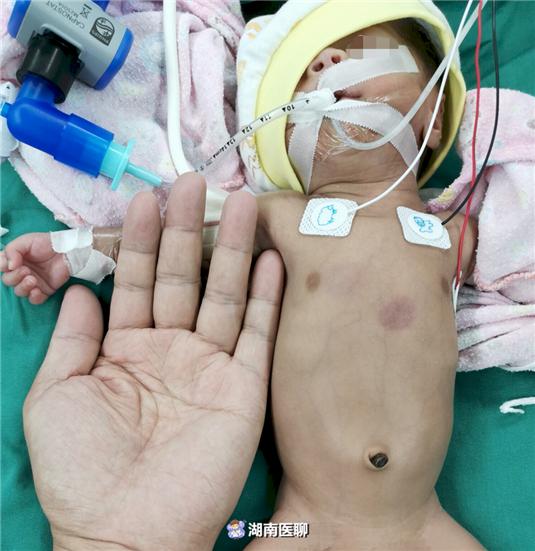 “巴掌宝宝”迎生命挑战：胰腺先天畸形，医生微小空间解肠道梗阻