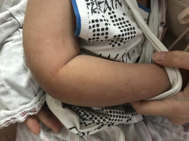 孩子骨折，准备手术，术前发生了这事，只能往后推迟几小时