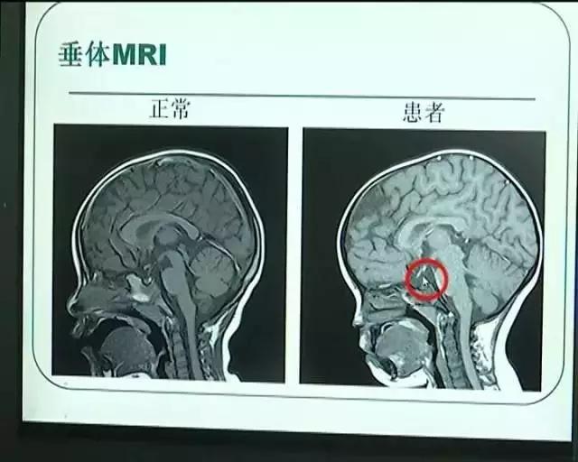 女孩7岁乳房发育，8岁来例假，只因家长做了这事