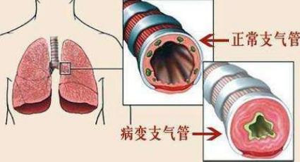 孩子爱咳嗽？家长要知道这5个原因，别弄错害了孩子