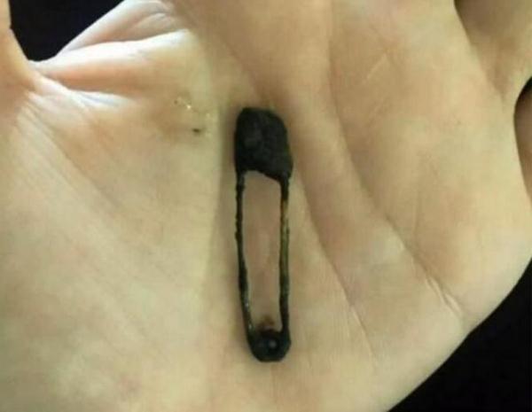 5岁小女孩一直流超臭青鼻涕6个月后，抠出不可能放进去物体