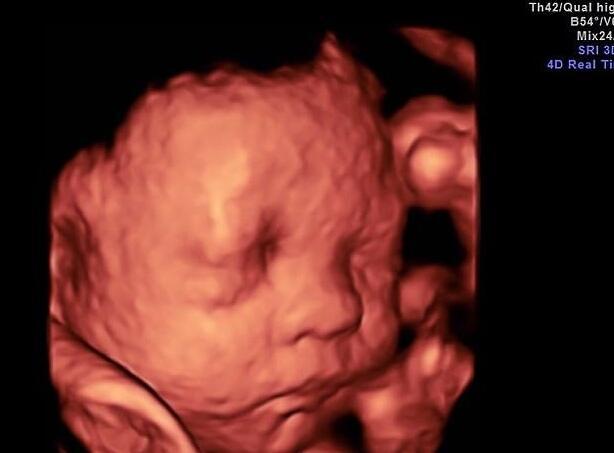 孕妈去医院做四维彩超，医生照了半天没看清，还需要再去吗？