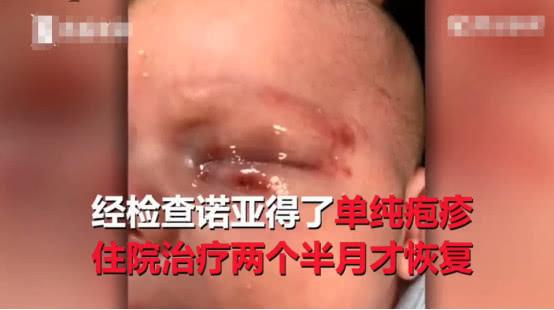 小宝宝被人亲了一下，不久后差点失明，住院两个半月才康复