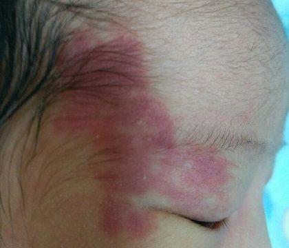 孩子身上有胎记？那是宝妈在怀孕时的这5个坏习惯，埋下的“根”