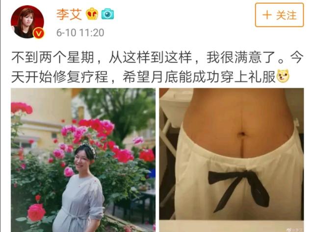 李艾顺产坐月子肚子已平坦，“妊娠线”却很抢镜，暗藏什么小秘密