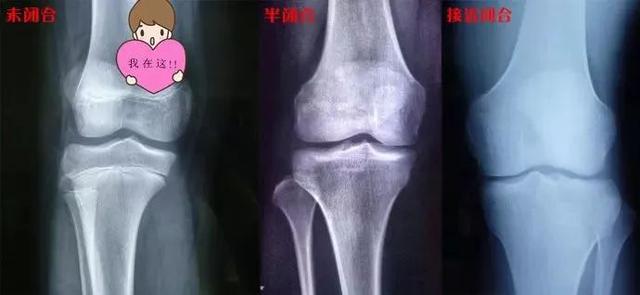 父母必看！孩子身体里的这条“线”，藏着身高的秘密！你知道吗？