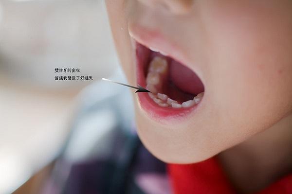 乳牙没掉，恒牙就长了出来？预防宝宝恒牙不整齐，宝妈要做到这些