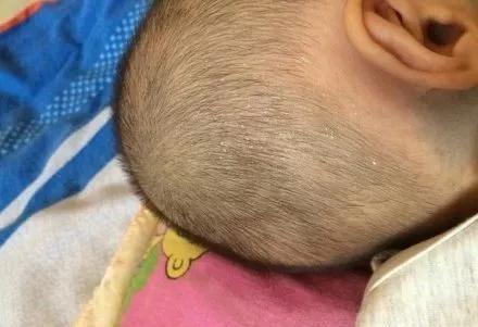 夏天炎热，宝宝睡觉出汗多正常吗？1招教你分辨正常出汗和盗汗