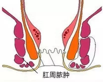 20多天的婴儿肛周脓肿，怎么回事？