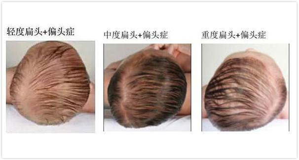 宝宝偏头，是因为睡觉姿势不变？宝妈这时候辛苦点，宝宝以后受益