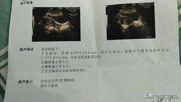 卧床“保胎”的方法真的有用吗？产科医生：没必要那么矫情