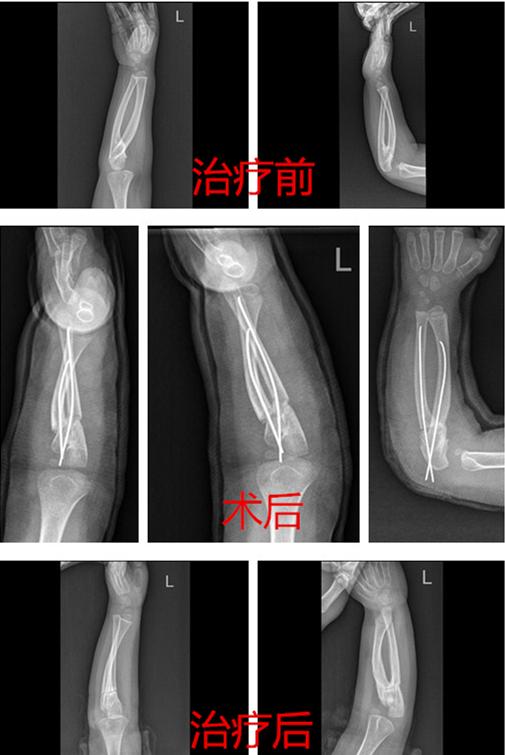 孩子掌心始终无法朝上，儿童骨科医生：这是一种比较罕见的疾病