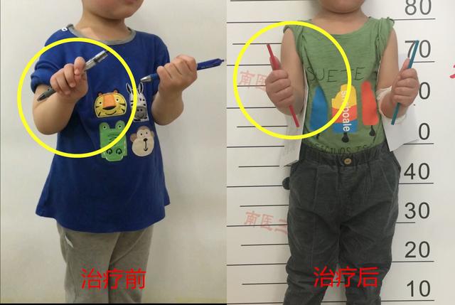 孩子掌心始终无法朝上，儿童骨科医生：这是一种比较罕见的疾病