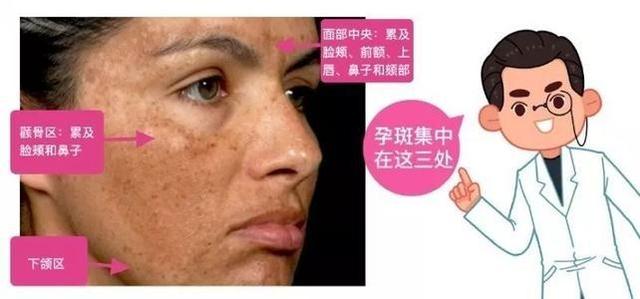妊娠斑影响外表形象心也不爽，产后妈妈该如何淡化妊娠斑？