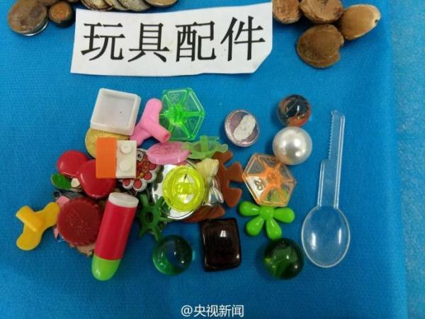 被熊孩子吞过的异物