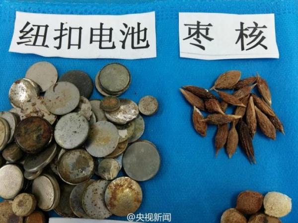 被熊孩子吞过的异物