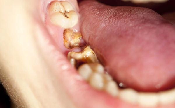 宝宝要换牙，龋齿的危害就没了？错！龋齿科普别忽视