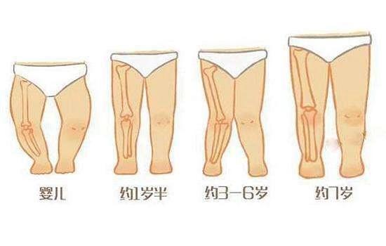 儿童骨科医生解答：所有的X型腿O型腿都要治疗吗？