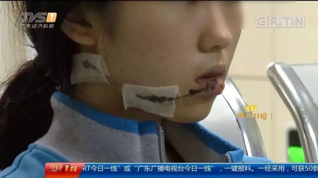 15岁女孩被男子用刀片划脸缝70针！孩子：远离你身边的垃圾人