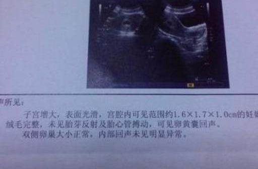 怀孕后，胎芽出现时间的早晚，与胎儿性别有关吗？孕妈不妨了解