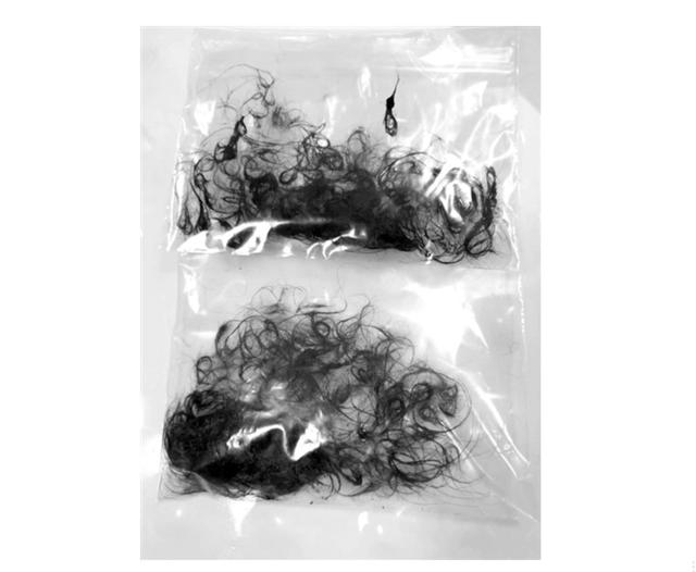 三岁幼童胃中取出两袋头发，当娃出现这些情况，或是异食癖的表现