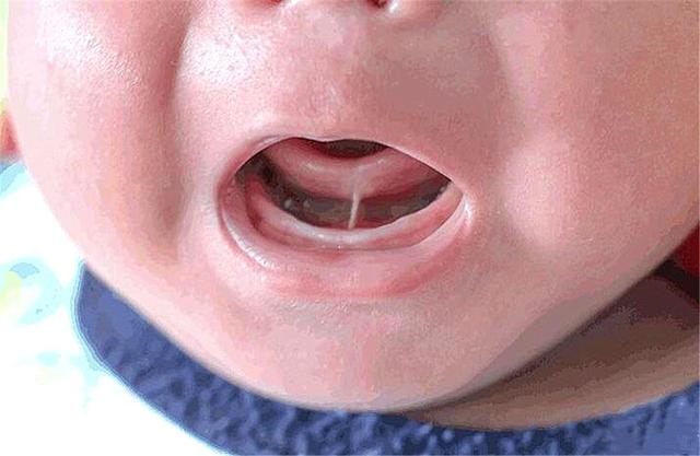2、3岁的孩子，说话含糊不清，有可能是“舌系带短”