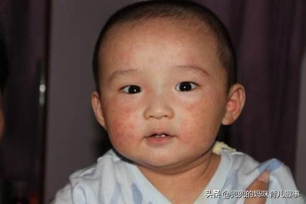 宝宝第一次发烧怎么办？别忙着吃退烧药，很可能是幼儿急疹