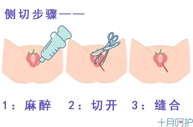 生孩子时下面被剪了一刀，会影响夫妻生活吗？其实很多人都误会了