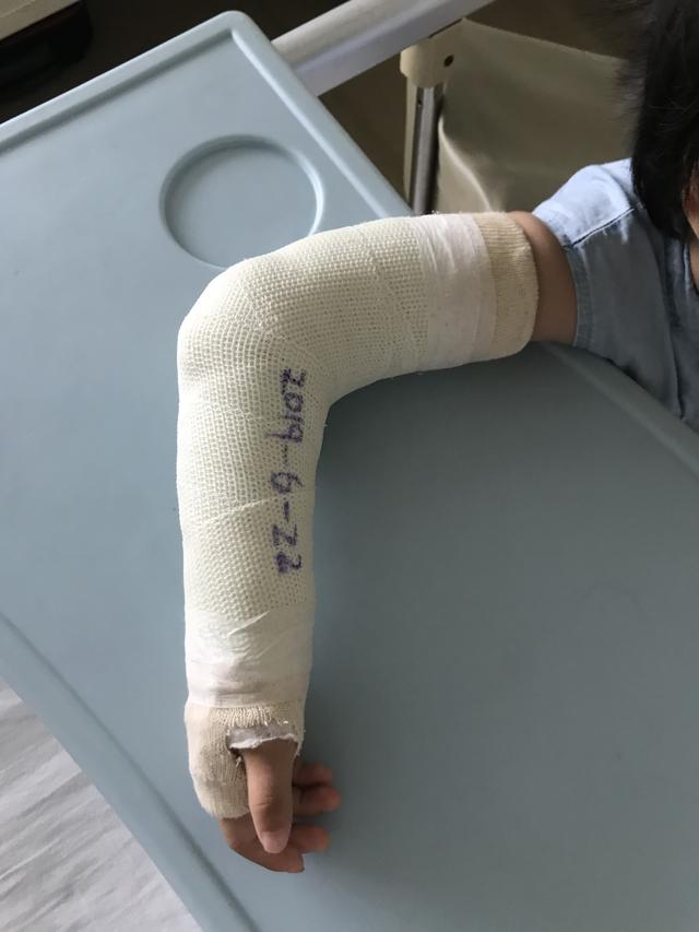 骨折后打了石膏，骨科医生必须交代患者的几件事