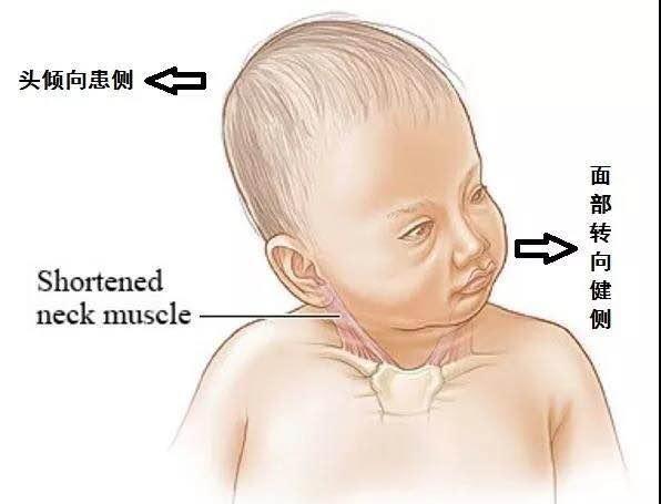 小孩“歪脖子”，确诊了先天性肌斜颈要怎么办？