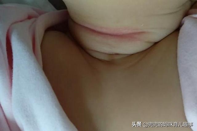宝宝“淹脖子”老反复发作，父母不注意这些，可能很难痊愈