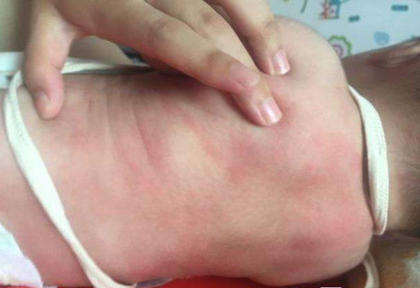 孩子剃光头不长痱子？夏季宝宝起痱子的应对误区，宝爸宝妈请远离